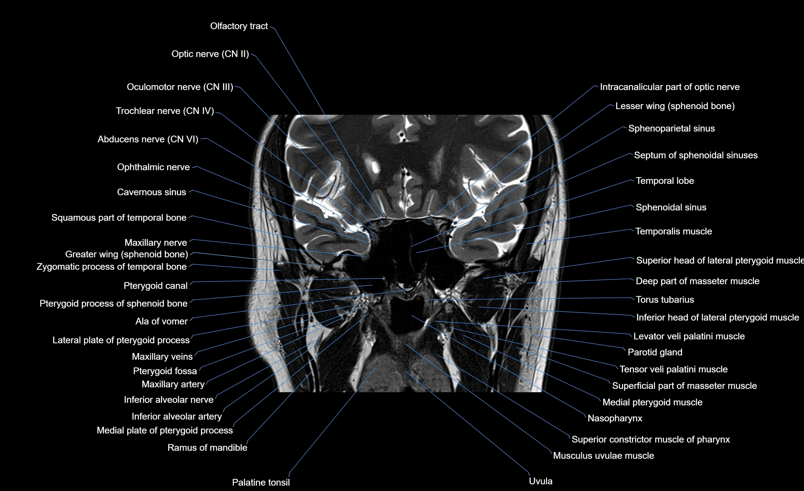 MRI face & paranasal sinuses(PNS) labelled  coronal  cross sectional anatomy 3T radiology  image-img-00001-00032.webp